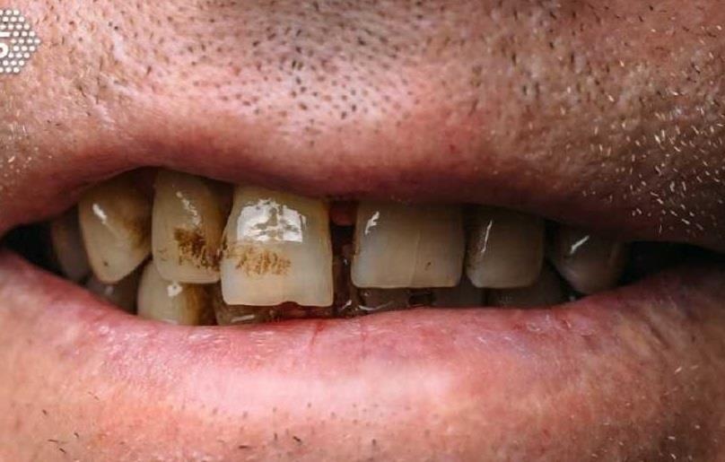 Thanh nien bi ung thu giai doan cuoi vi an trau va hut thuoc hinh anh