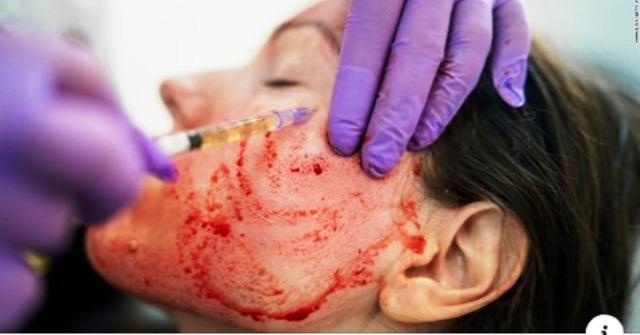 Nguy cơ từ lăn kim trẻ hóa làn da ảnh 1 Nguy co tu lan kim tre hoa lan da anh 1
