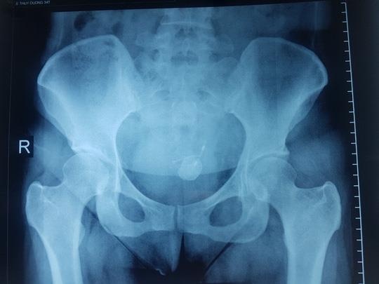 Dị vật trong bàng quang ảnh 1 Di vat trong bang quang anh 1