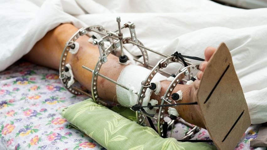 Thanh cong moi trong trien khai phau thuat keo dai chan hinh anh