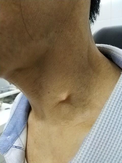 Xương cá đâm thủng hạ họng ảnh 1 Xuong ca dam thung ha hong anh 1