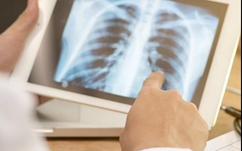 He thong tri tue nhan tao giup phat hien som ung thu phoi hinh anh