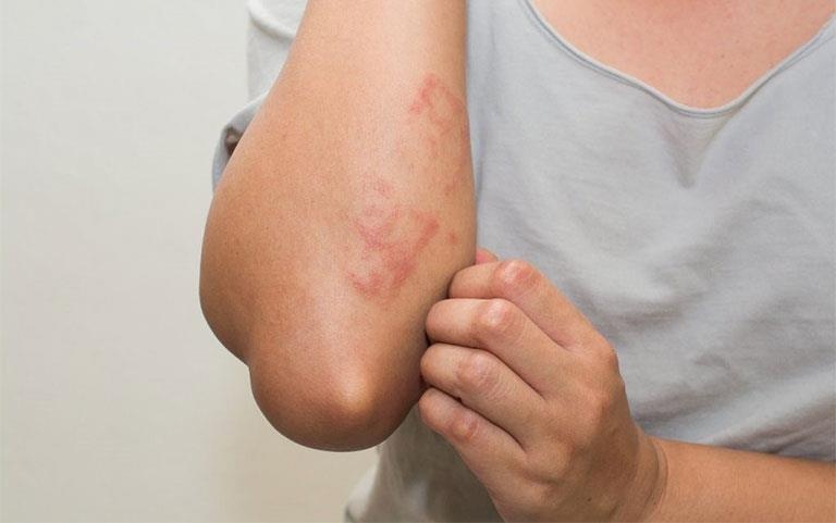 Can benh khien co gai thich viet chu len da hinh anh