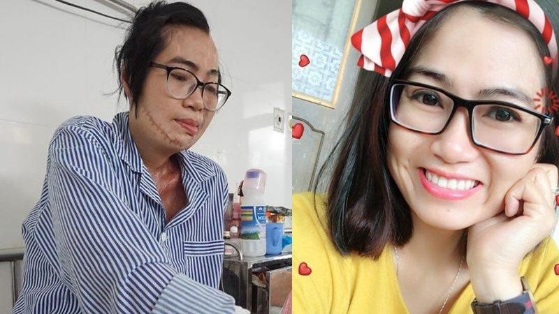 Bị người yêu, chồng tạt axit ảnh 2 Bi nguoi yeu, chong tat axit anh 2