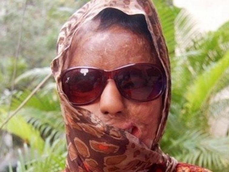 Co gai bi tat axit tham gia 'Ai la trieu phu' de kiem tien dieu tri hinh anh