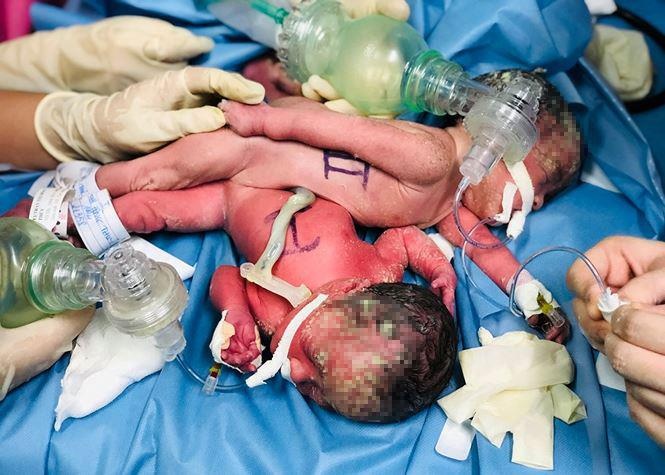 Song sinh dính liền ảnh 1 Song sinh dinh lien anh 1