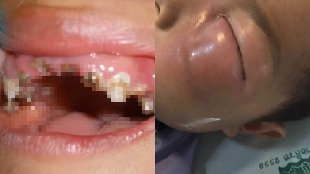 Bé trai suýt mù vì sâu răng ảnh 1 Be trai suyt mu vi sau rang anh 1