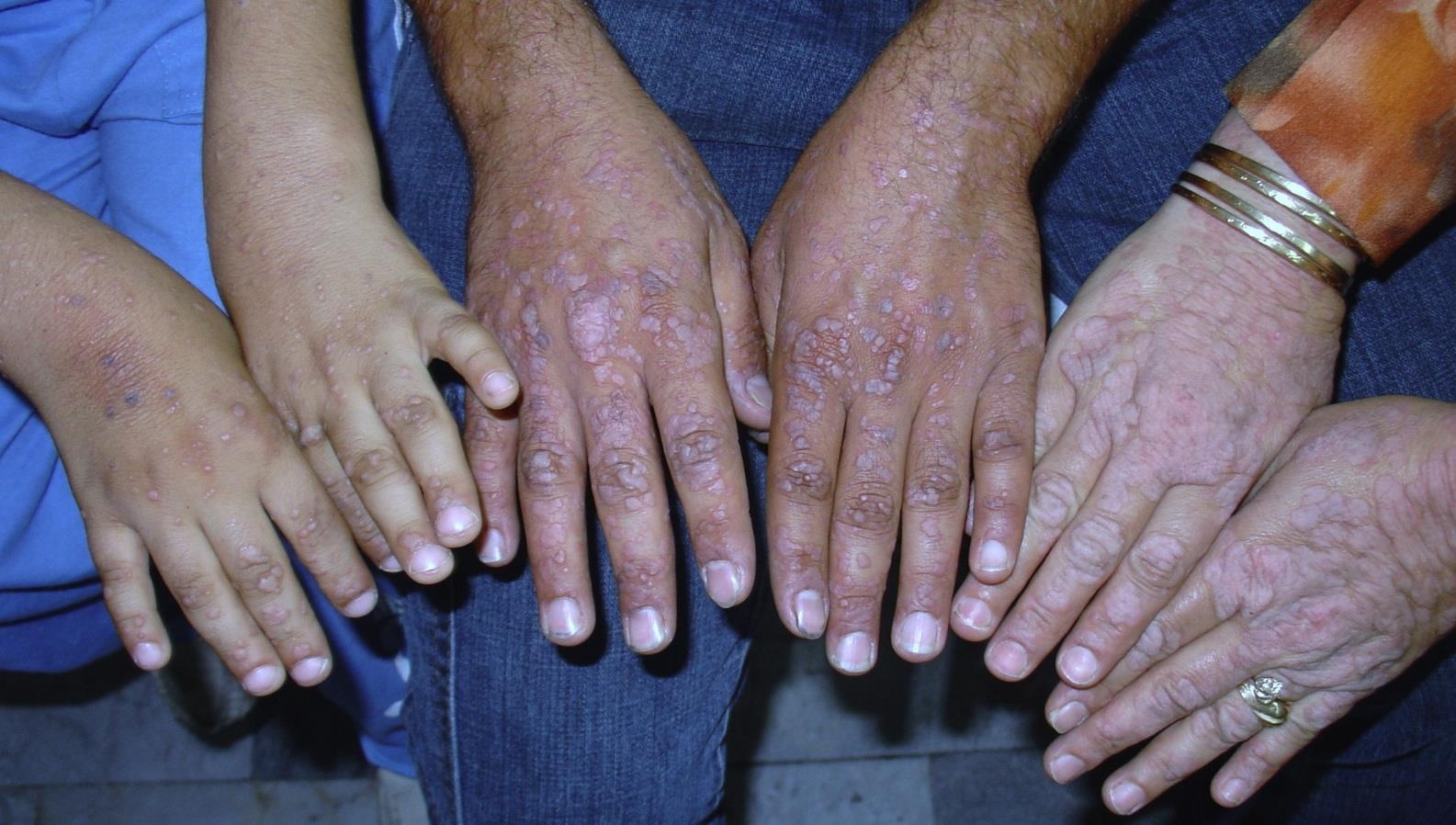 benh nguoi cay anh 4