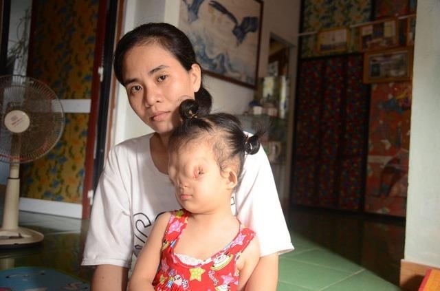 Cô bé mang dị tật hiếm gặp ảnh 1 Co be mang di tat hiem gap anh 1
