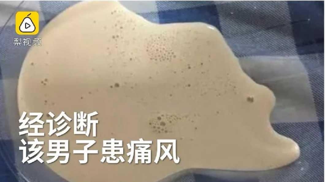 Bị gout vì uống bia hàng ngày ảnh 1 Bi gout vi uong bia hang ngay anh 1