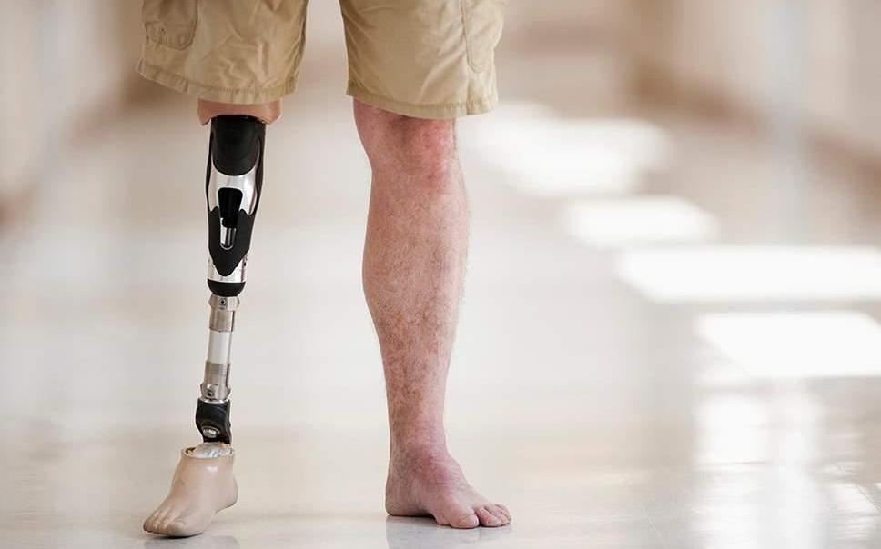 Chung roi loan quai la khien nguoi benh muon cat tay chan hinh anh