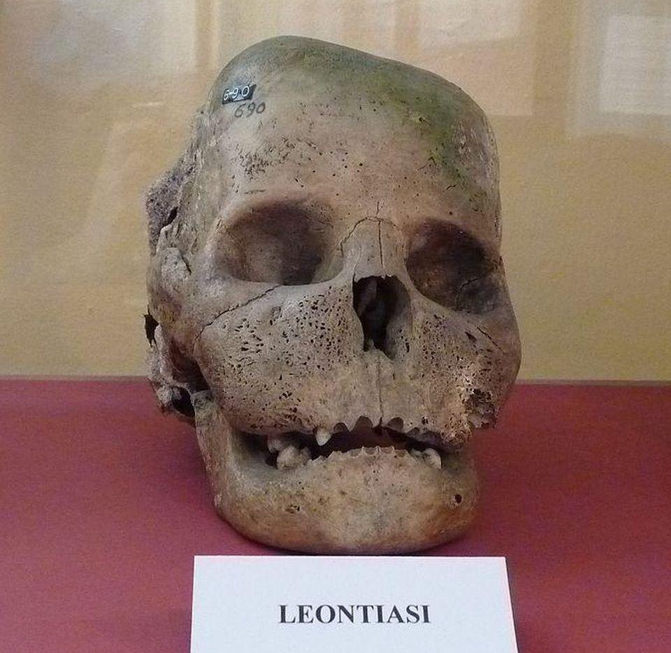 Hoi chung mat su tu anh 2