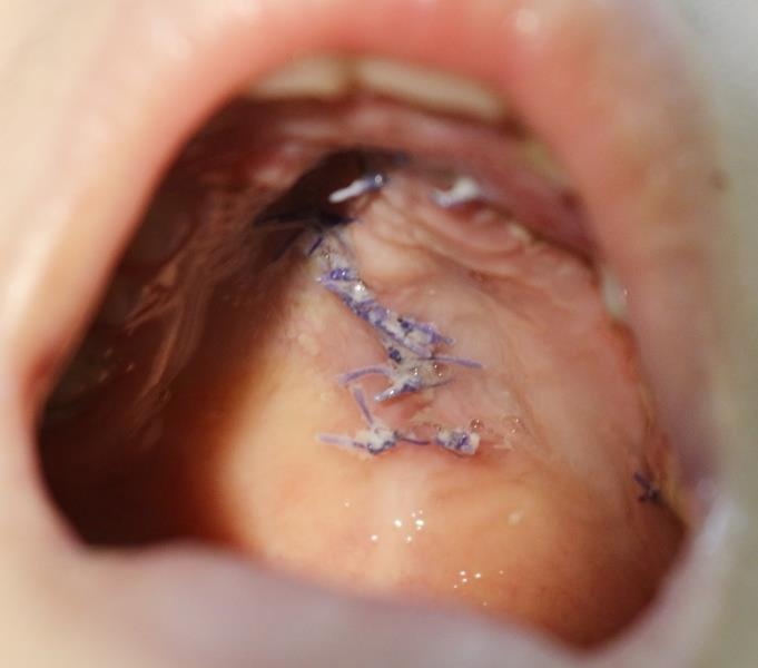 Thủng vòm miệng do ngã xe đạp ảnh 1 Thung vom mieng do nga xe dap anh 1