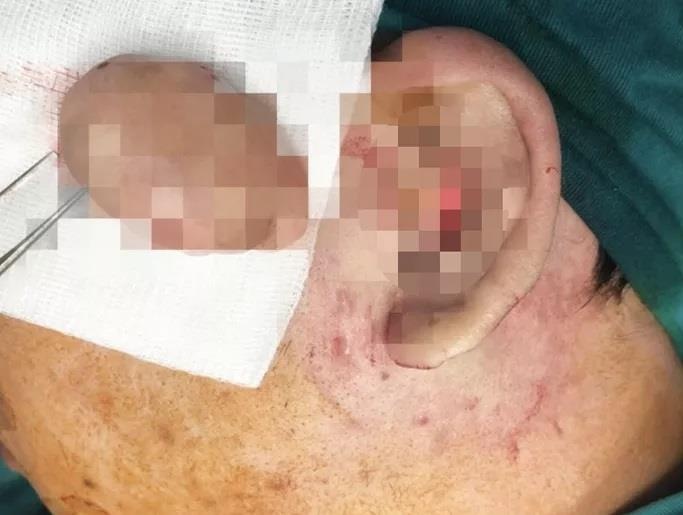 Biến dạng tai vì xỏ khuyên ảnh 1 Bien dang tai vi xo khuyen anh 1