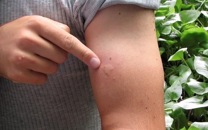 Cach phan biet cac loai vet dot cua con trung hinh anh