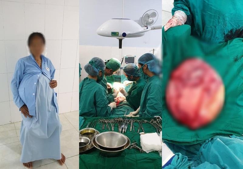 Khối u buồng trứng 25 kg ảnh 1 Khoi u buong trung 25 kg anh 1