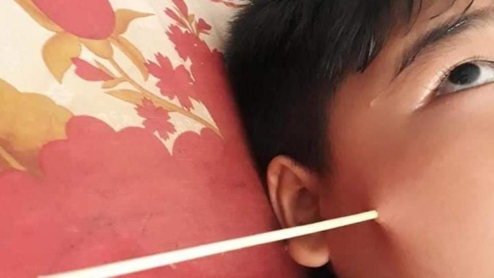 Học sinh bị đâm thủng mặt ảnh 1 Hoc sinh bi dam thung mat anh 1