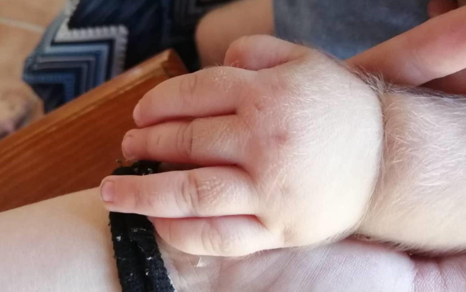 17 tre mac hoi chung 'nguoi soi' sau khi uong thuoc da day hinh anh