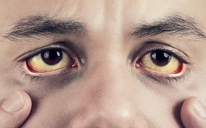 Trieu chung bat thuong o mat khong nen bo qua hinh anh