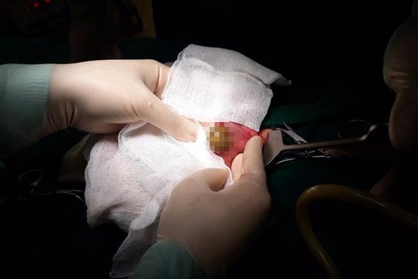 Bé gái tắc ruột vì ăn hồng ảnh 1 Be gai tac ruot vi an hong anh 1