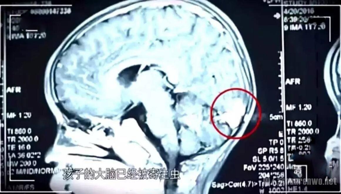 Tổn thương não vì ăn mật rắn ảnh 1 Ton thuong nao vi an mat ran anh 1