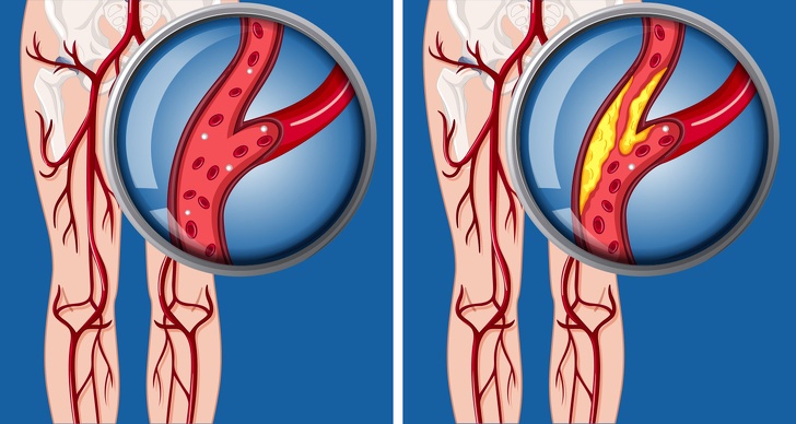 Viem vu va ung thu vu anh 4