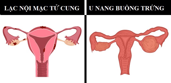 Viem vu va ung thu vu anh 6