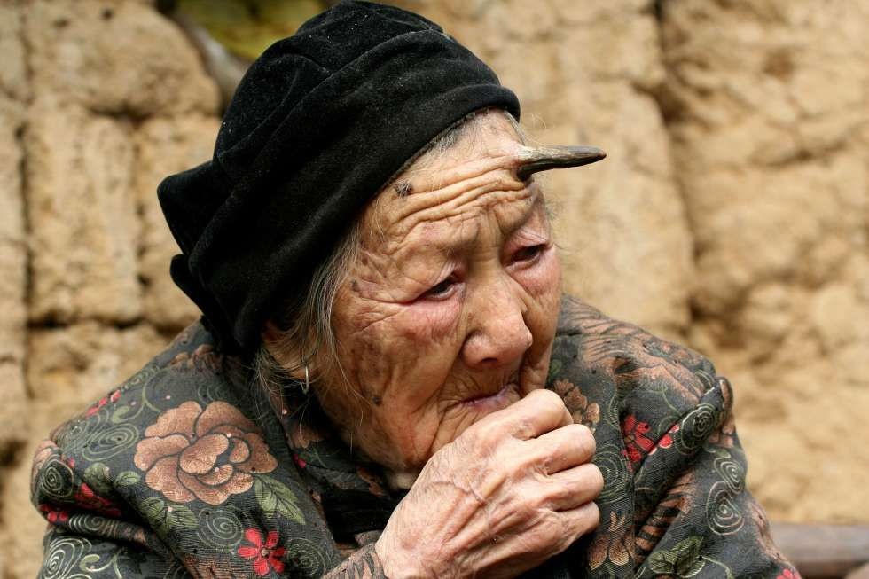 Can benh sung da anh 3