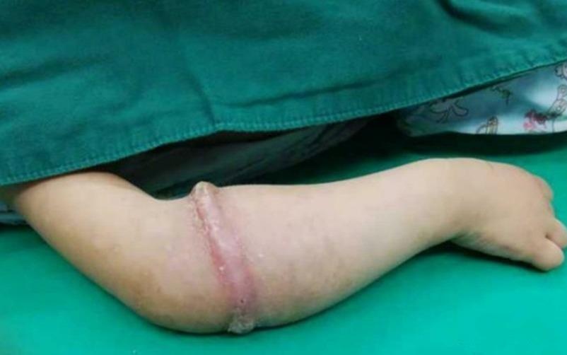 Tay be gai bien dang vi chiec nit cao su hinh anh