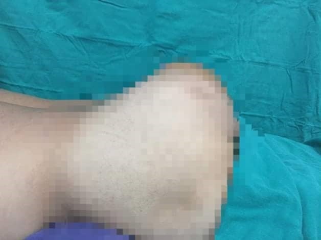Khối u khủng vùng cụt ảnh 1 Khoi u khung vung cut anh 1