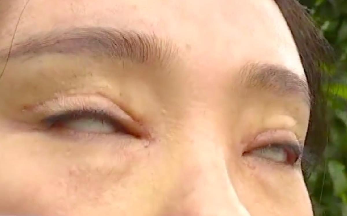 Co gai khong the nham mat sau khi phau thuat cat mi hinh anh