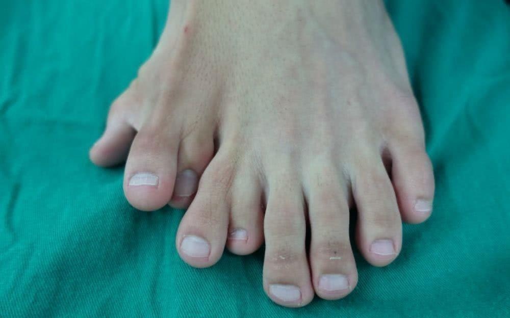 Chang trai 21 tuoi co 9 ngon tren mot ban chan hinh anh