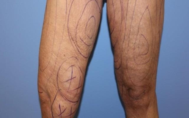 Thanh nien nhap vien sau khi hut mo dui hinh anh