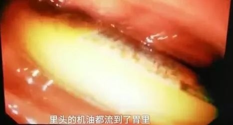 Nuốt bật lửa khi say rượu ảnh 1 Nuot bat lua khi say ruou anh 1