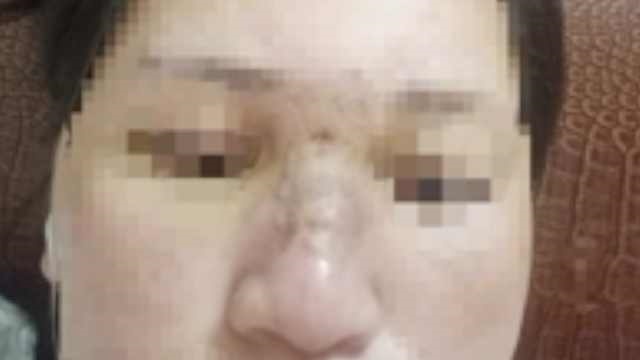 Nguoi phu nu bi sung phu mat sau khi tiem filler lam dep hinh anh