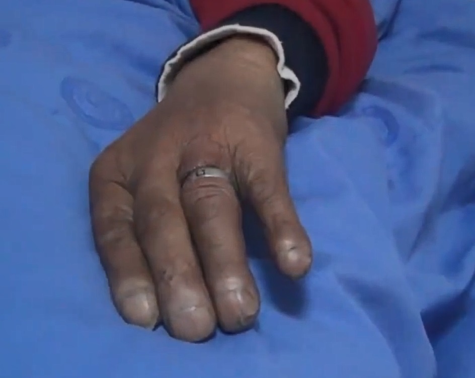 Ngon tay bi loet, suyt hoai tu vi deo nhan qua chat hinh anh