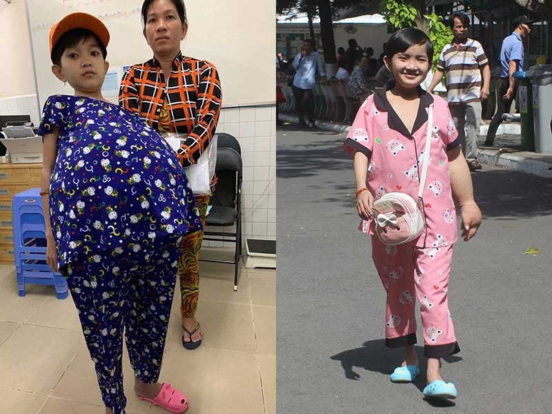 Co gai co khoi u 50 kg anh 1