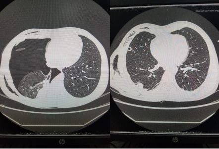 Nguy kịch do tràn khí màng phổi ảnh 2 Nguy kich do tran khi mang phoi anh 2