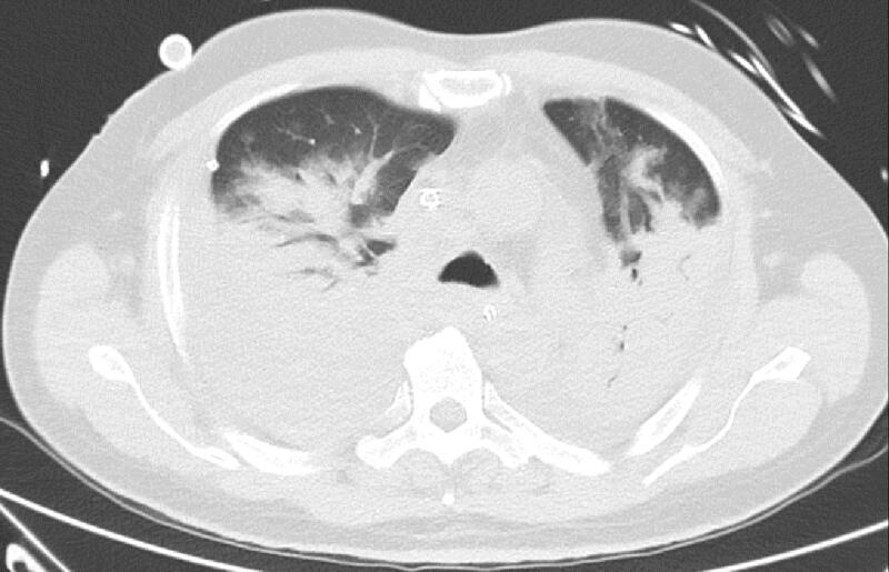 Benh nhan mac Covid-19 ngung tim anh 1
