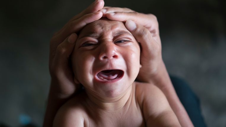 Biến chứng của virus Zika ảnh 2 Bien chung cua virus Zika anh 2
