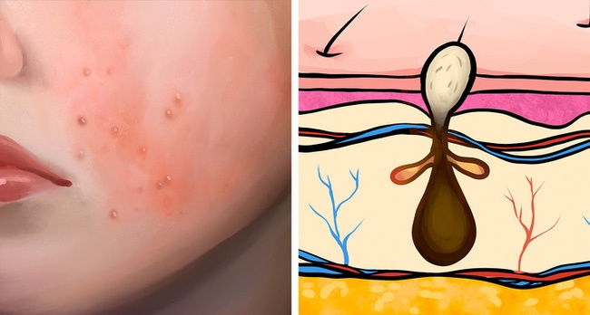 Cac loai mun trung ca pho bien anh 1