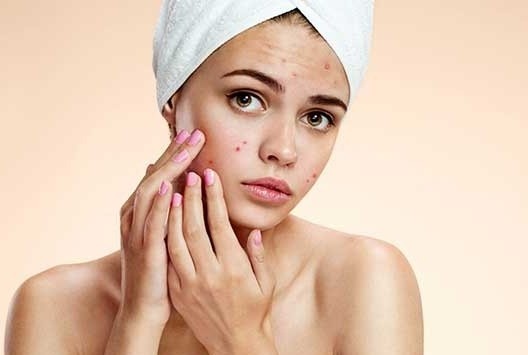 Su that ve nguyen nhan cac loai mun trung ca xuat hien hinh anh