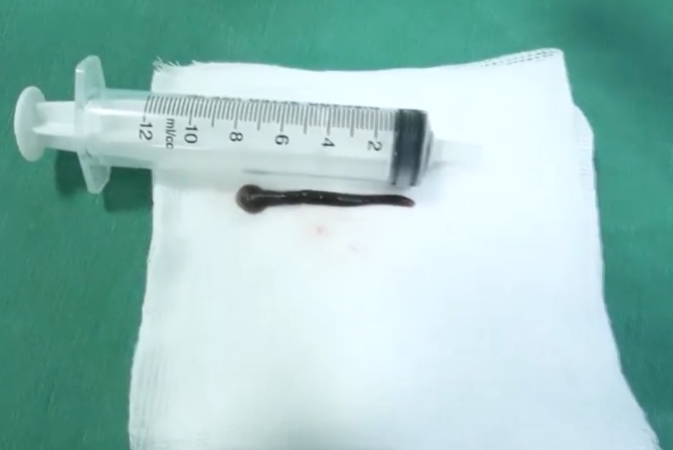 Vắt dài 8 cm sống trong khí quản ảnh 1 Vat dai 8 cm song trong khi quan anh 1