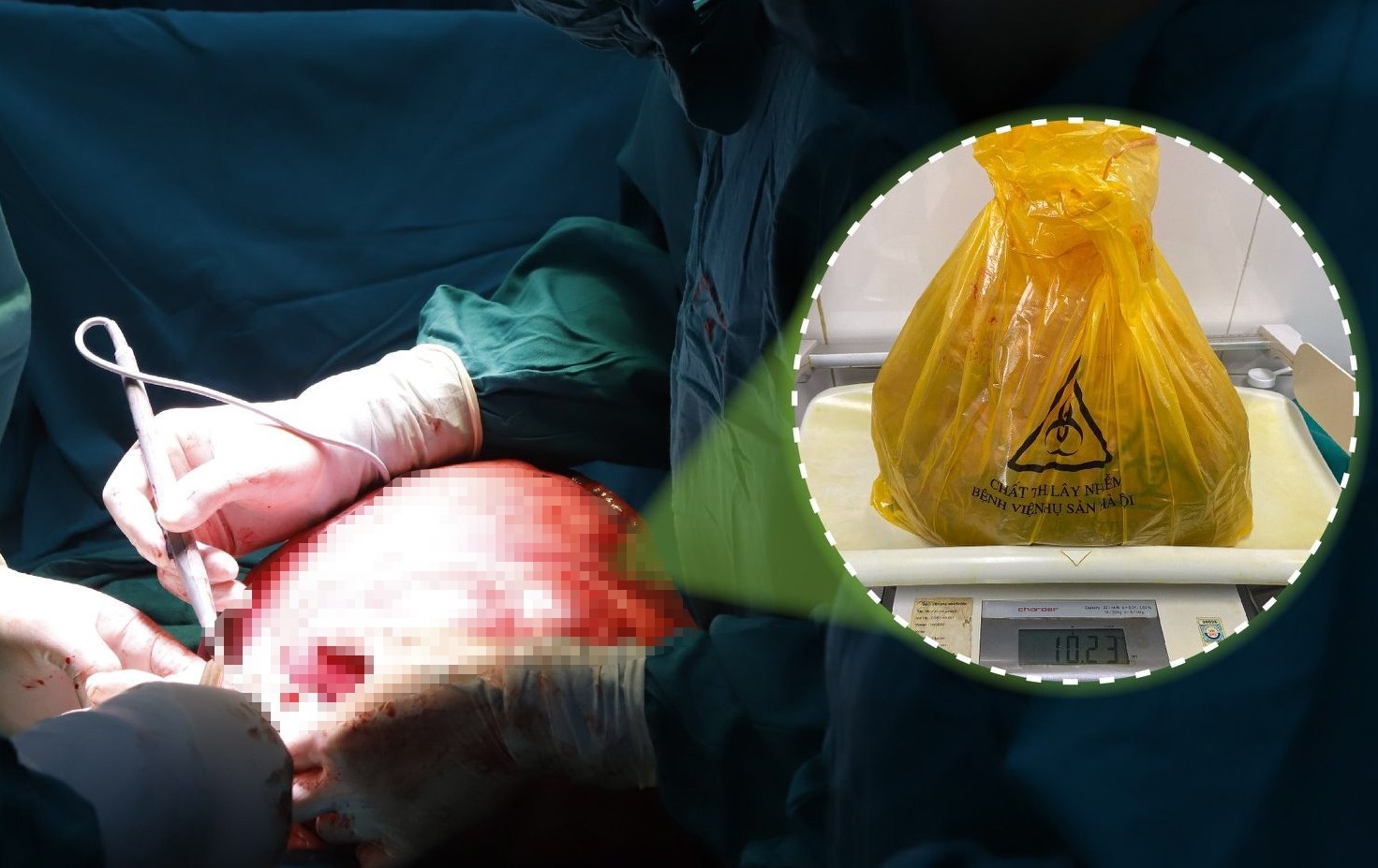 Khối u xơ tử cung nặng 10 kg ảnh 1 Khoi u xo tu cung nang 10 kg anh 1