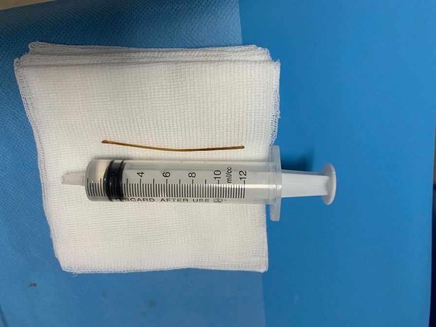 Dung ky thuat chua tung co trong y van lay tam trong bung benh nhan hinh anh