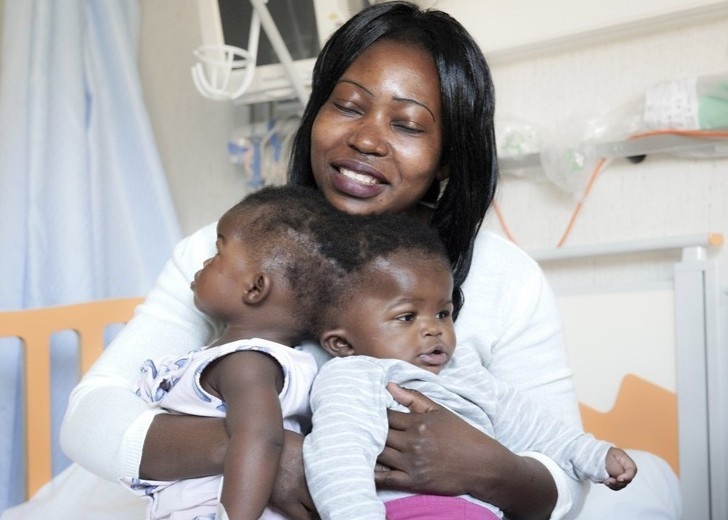 Tach dau thanh cong cho cap song sinh dinh lien hiem gap hinh anh