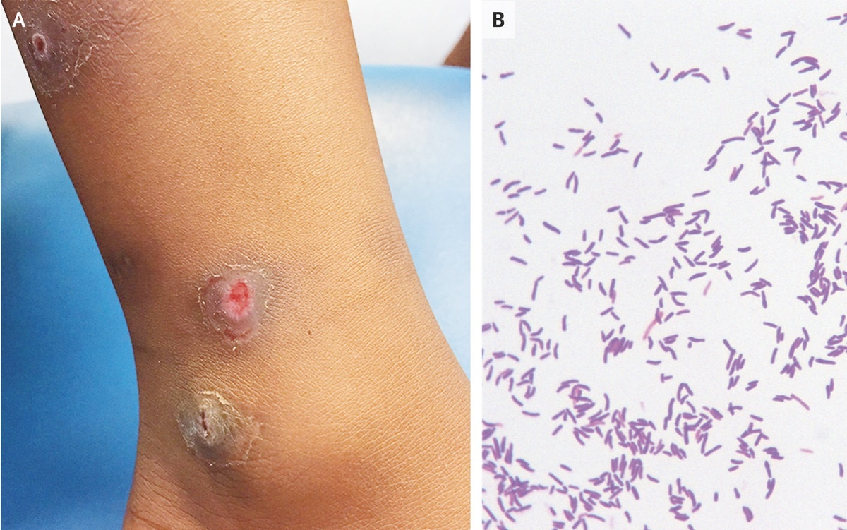 Bệnh bạch hầu ở da ảnh 1 Benh bach hau o da anh 1