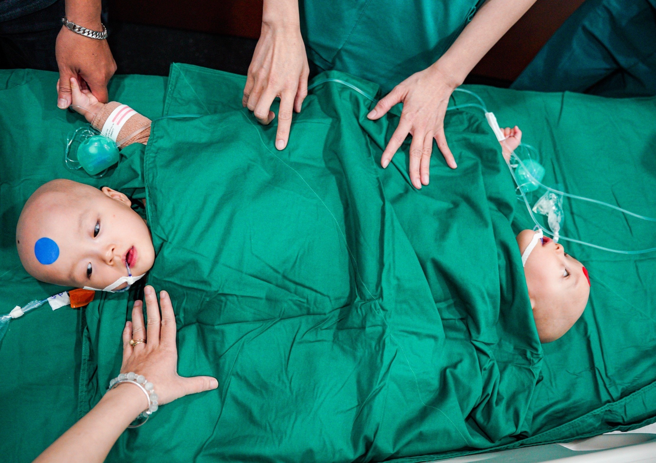 Ke hoach cua 100 y bac si trong 12 tieng mo tach song sinh dinh lien hinh anh