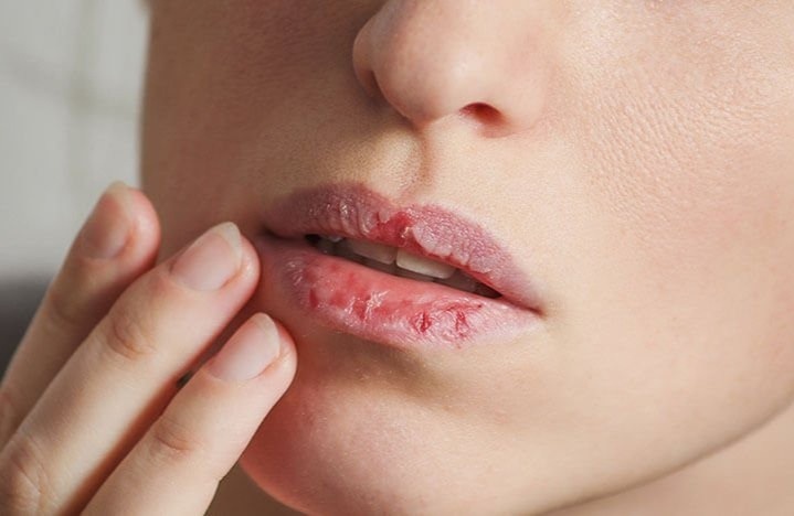 Nguyen nhan khien moi nut ne khi troi lanh hinh anh