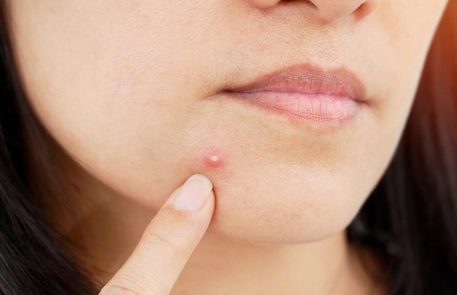 Mun trung ca hinh thanh nhu the nao? hinh anh